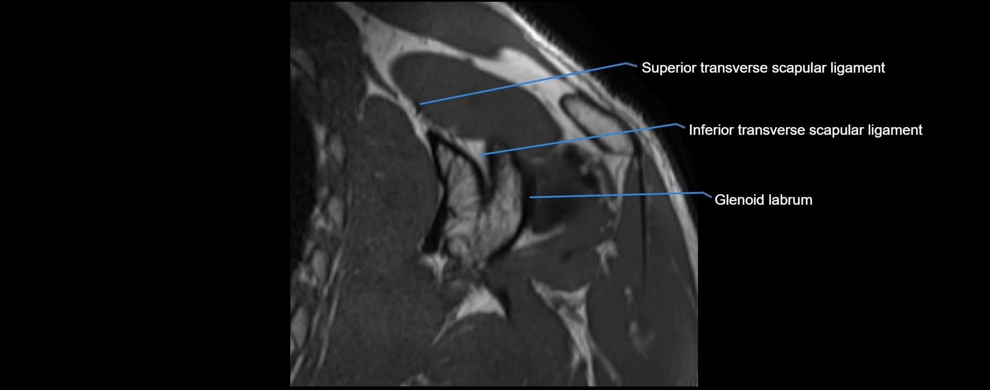 shoulder ligments coronal  cross sectional anatomy 3T MRI AI enhanced radiology image -img-00001-00035.webp